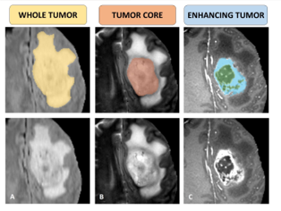AI-Powered Brain MRI Tumor Segmentation